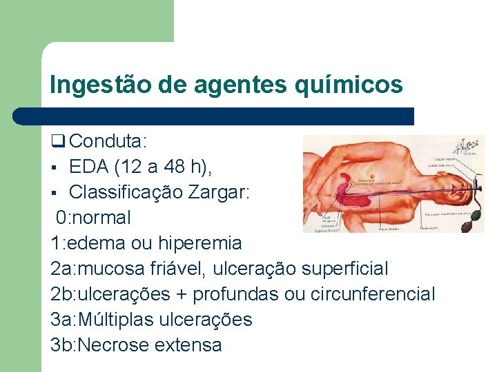 Ingestão de agentes químicos q Conduta: EDA (12 a 48 h), § Classificação Zargar: