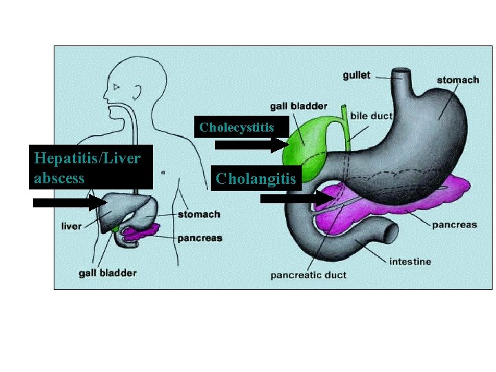 Cholecystitis Hepatitis/Liver abscess Cholangitis 