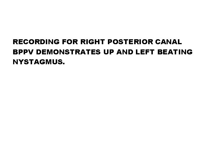 RECORDING FOR RIGHT POSTERIOR CANAL BPPV DEMONSTRATES UP AND LEFT BEATING NYSTAGMUS. 