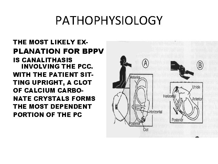 PATHOPHYSIOLOGY THE MOST LIKELY EX- PLANATION FOR BPPV IS CANALITHASIS INVOLVING THE PCC. WITH