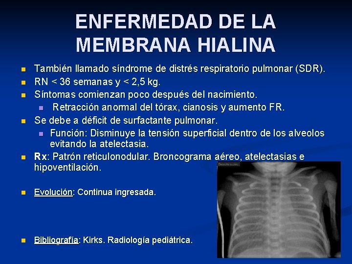 ENFERMEDAD DE LA MEMBRANA HIALINA n n n También llamado síndrome de distrés respiratorio