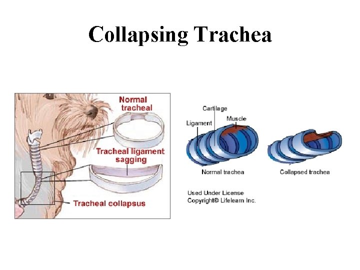 Collapsing Trachea 