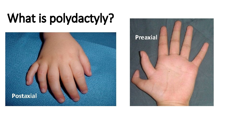 What is polydactyly? Preaxial Postaxial 