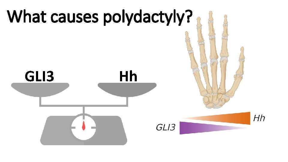 What causes polydactyly? GLI 3 Hh 