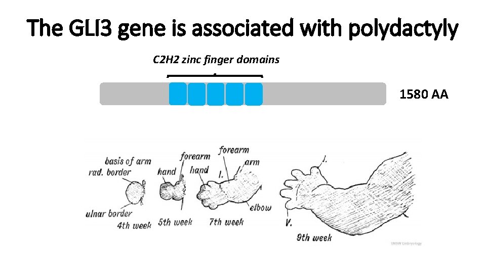 The GLI 3 gene is associated with polydactyly C 2 H 2 zinc finger