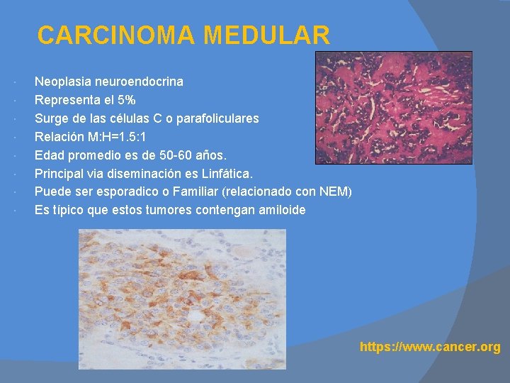 CARCINOMA MEDULAR Neoplasia neuroendocrina Representa el 5% Surge de las células C o parafoliculares