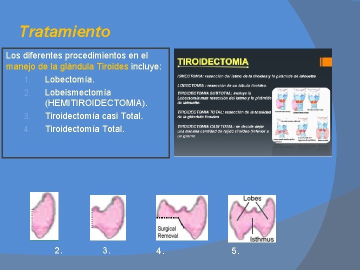 Tratamiento Los diferentes procedimientos en el manejo de la glándula Tiroides incluye: 1. Lobectomía.