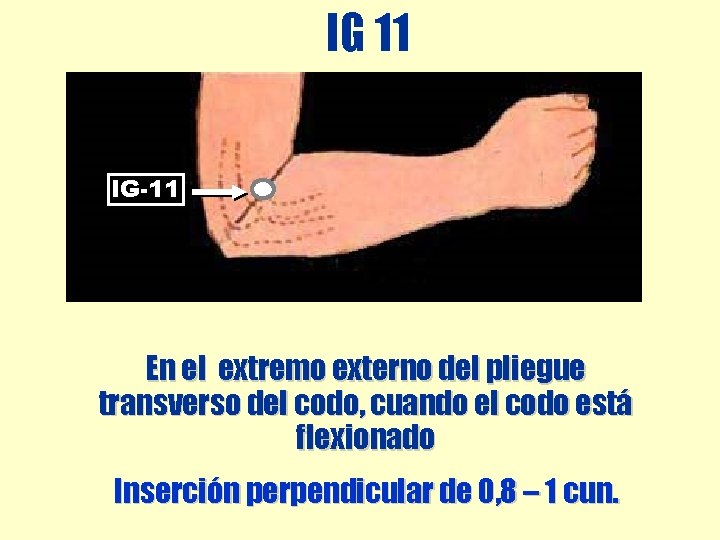 IG 11 IG-11 En el extremo externo del pliegue transverso del codo, cuando el IG 11 IG-11 En el extremo externo del pliegue transverso del codo, cuando el