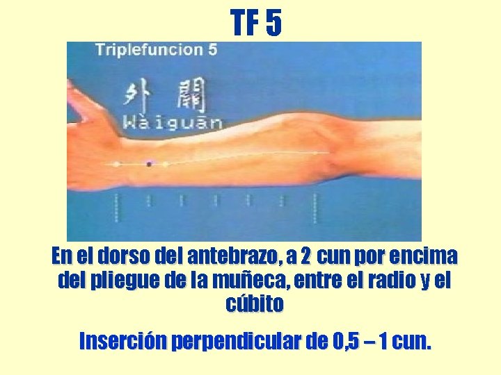 TF 5 En el dorso del antebrazo, a 2 cun por encima del pliegue TF 5 En el dorso del antebrazo, a 2 cun por encima del pliegue