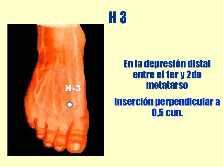 H 3 H-3 En la depresión distal entre el 1 er y 2 do H 3 H-3 En la depresión distal entre el 1 er y 2 do