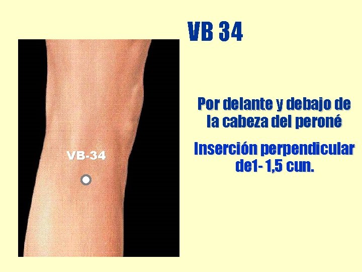 VB 34 Por delante y debajo de la cabeza del peroné VB-34 Inserción perpendicular VB 34 Por delante y debajo de la cabeza del peroné VB-34 Inserción perpendicular