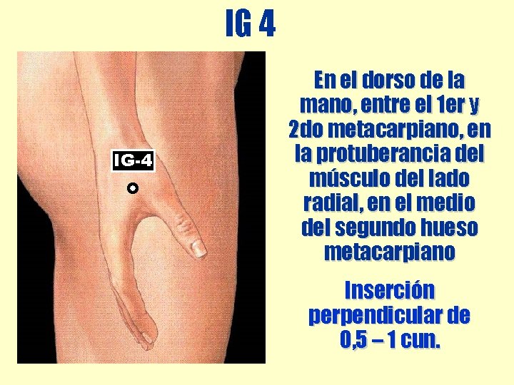 IG 4 IG-4 En el dorso de la mano, entre el 1 er y IG 4 IG-4 En el dorso de la mano, entre el 1 er y