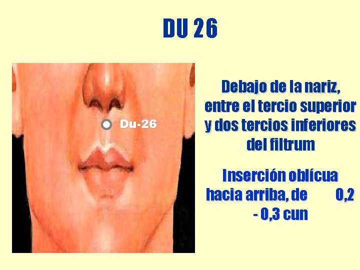 DU 26 Du-26 Debajo de la nariz, entre el tercio superior y dos tercios DU 26 Du-26 Debajo de la nariz, entre el tercio superior y dos tercios