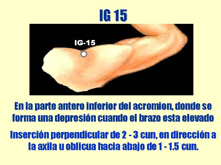 IG 15 IG-15 En la parte antero inferior del acromion, donde se forma una IG 15 IG-15 En la parte antero inferior del acromion, donde se forma una