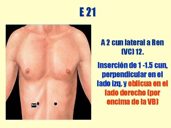 E 21 A 2 cun lateral a Ren (VC) 12. Inserción de 1 -1. E 21 A 2 cun lateral a Ren (VC) 12. Inserción de 1 -1.
