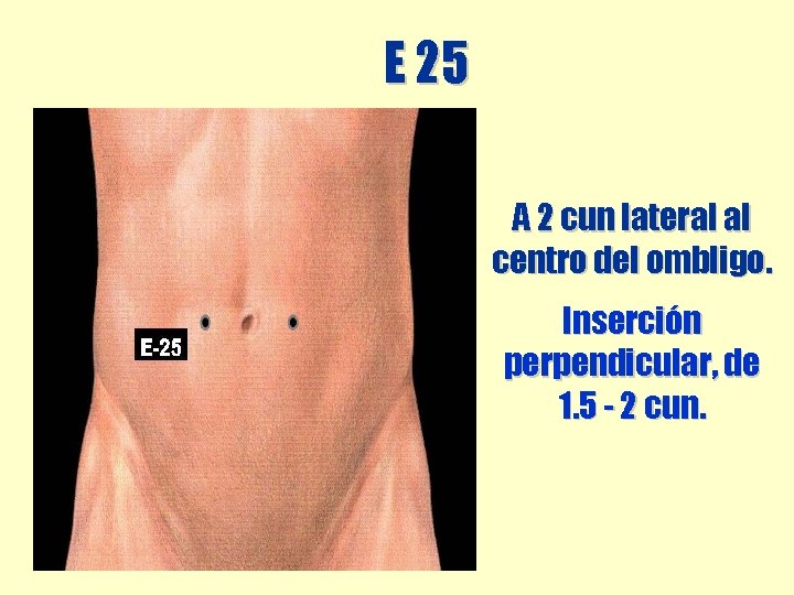 E 25 A 2 cun lateral al centro del ombligo. Inserción perpendicular, de 1. E 25 A 2 cun lateral al centro del ombligo. Inserción perpendicular, de 1.