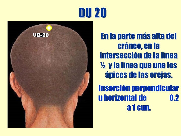 DU 20 VB-20 En la parte más alta del cráneo, en la intersección de DU 20 VB-20 En la parte más alta del cráneo, en la intersección de
