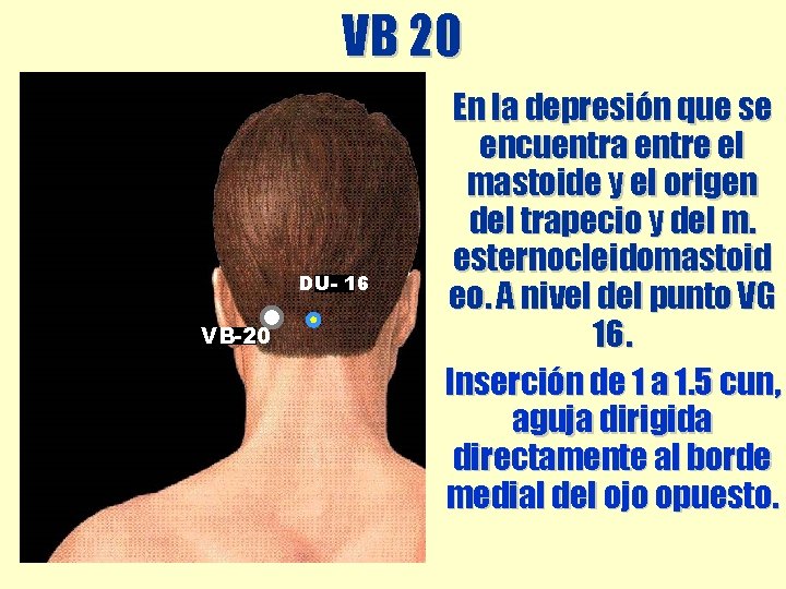 VB 20 DU- 16 VB-20 En la depresión que se encuentra entre el mastoide VB 20 DU- 16 VB-20 En la depresión que se encuentra entre el mastoide