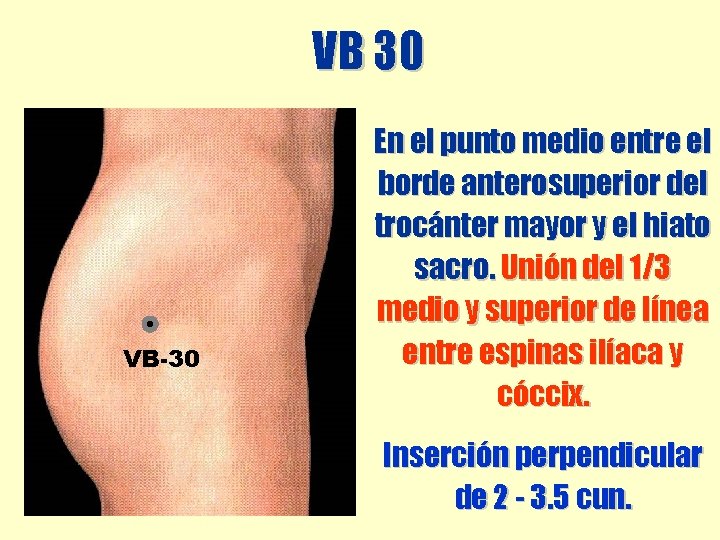VB 30 VB-30 En el punto medio entre el borde anterosuperior del trocánter mayor VB 30 VB-30 En el punto medio entre el borde anterosuperior del trocánter mayor