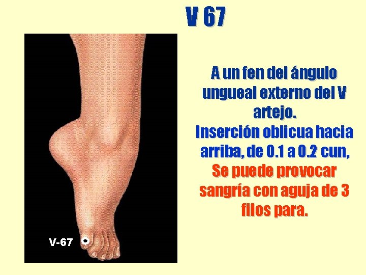 V 67 A un fen del ángulo ungueal externo del V artejo. Inserción oblicua V 67 A un fen del ángulo ungueal externo del V artejo. Inserción oblicua