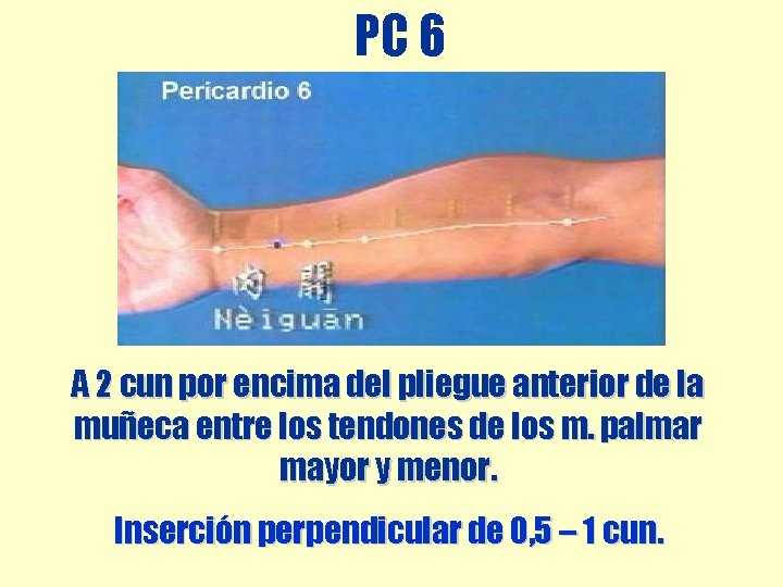PC 6 A 2 cun por encima del pliegue anterior de la muñeca entre PC 6 A 2 cun por encima del pliegue anterior de la muñeca entre