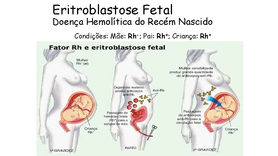 Eritroblastose Fetal Doença Hemolítica do Recém Nascido Condições: Mãe: Rh-; Pai: Rh+; Criança: Rh+