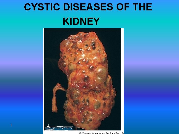 CYSTIC DISEASES OF THE KIDNEY 1 