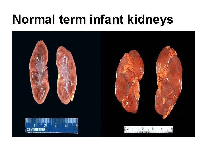 Normal term infant kidneys 