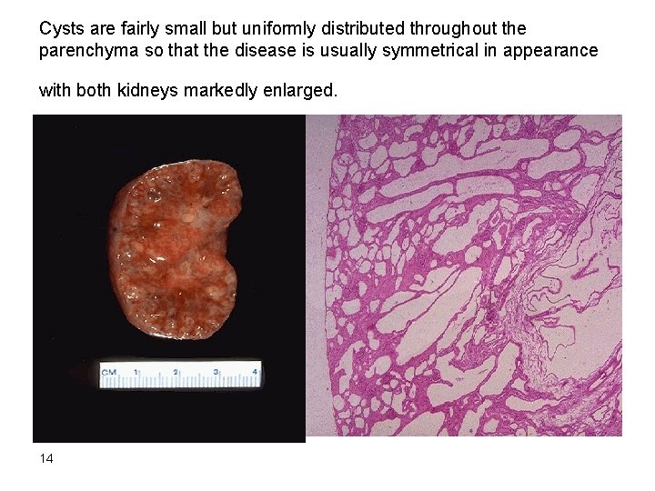Cysts are fairly small but uniformly distributed throughout the parenchyma so that the disease