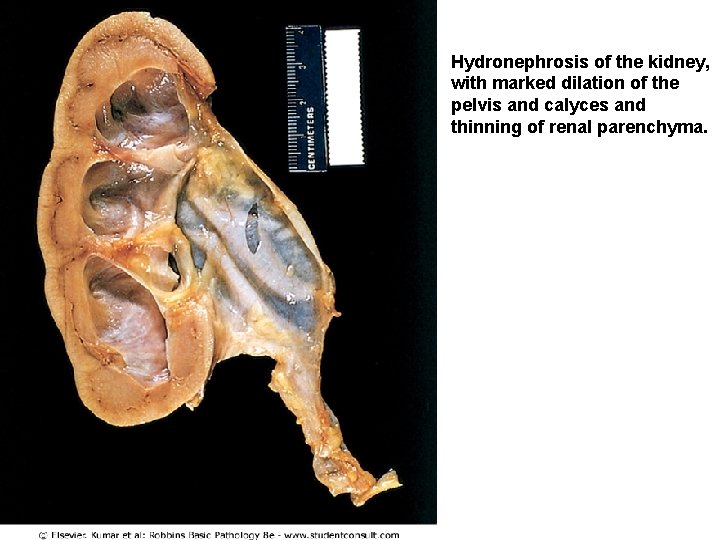 Hydronephrosis of the kidney, with marked dilation of the pelvis and calyces and thinning