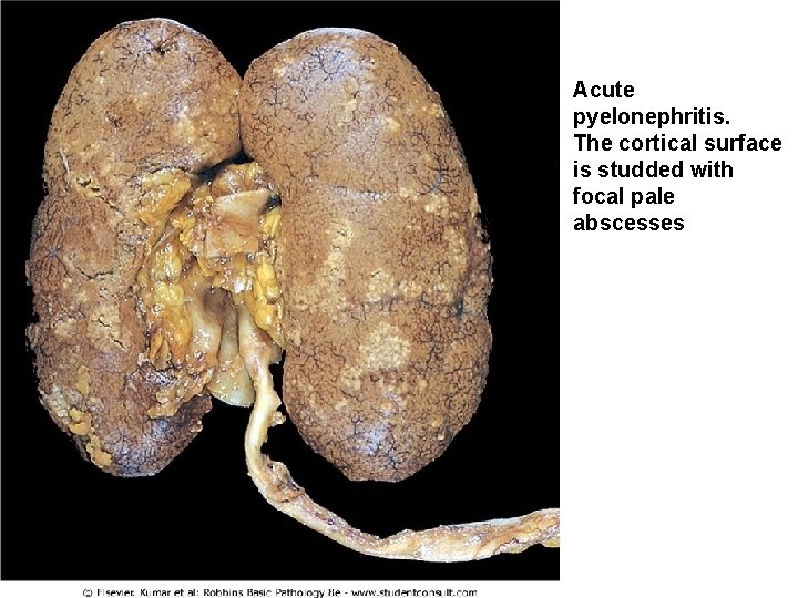 Acute pyelonephritis. The cortical surface is studded with focal pale abscesses 41 