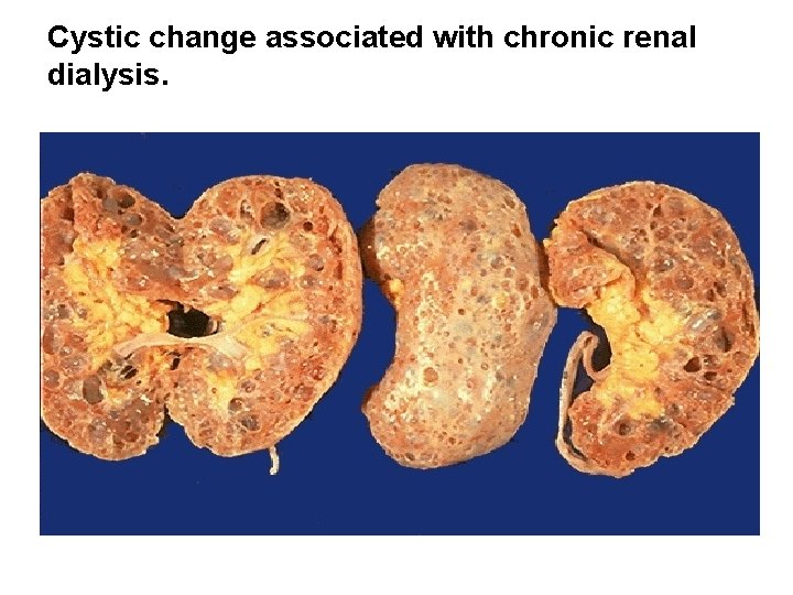 Cystic change associated with chronic renal dialysis. 