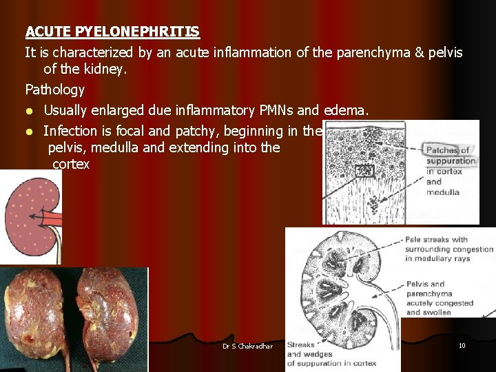 ACUTE PYELONEPHRITIS It is characterized by an acute inflammation of the parenchyma & pelvis