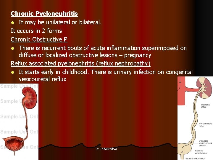 Chronic Pyelonephritis l It may be unilateral or bilateral. It occurs in 2 forms