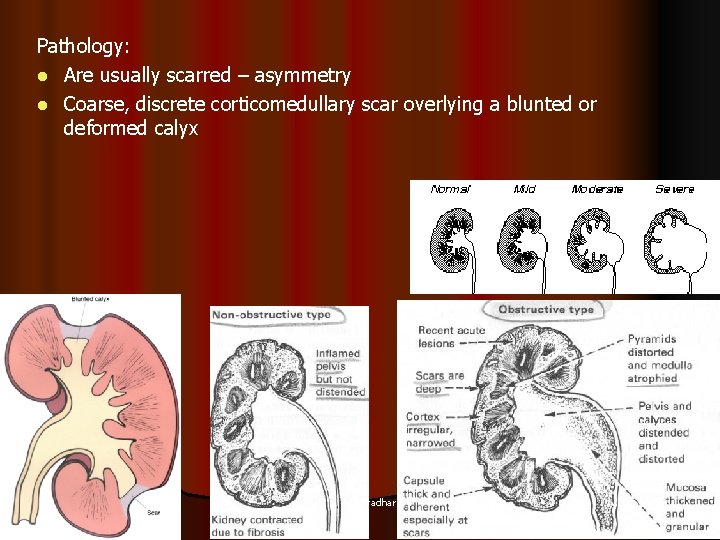 Pathology: l Are usually scarred – asymmetry l Coarse, discrete corticomedullary scar overlying a Pathology: l Are usually scarred – asymmetry l Coarse, discrete corticomedullary scar overlying a