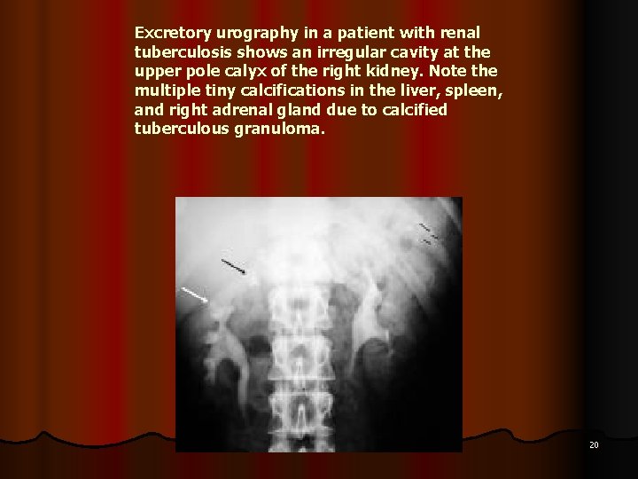 Excretory urography in a patient with renal tuberculosis shows an irregular cavity at the