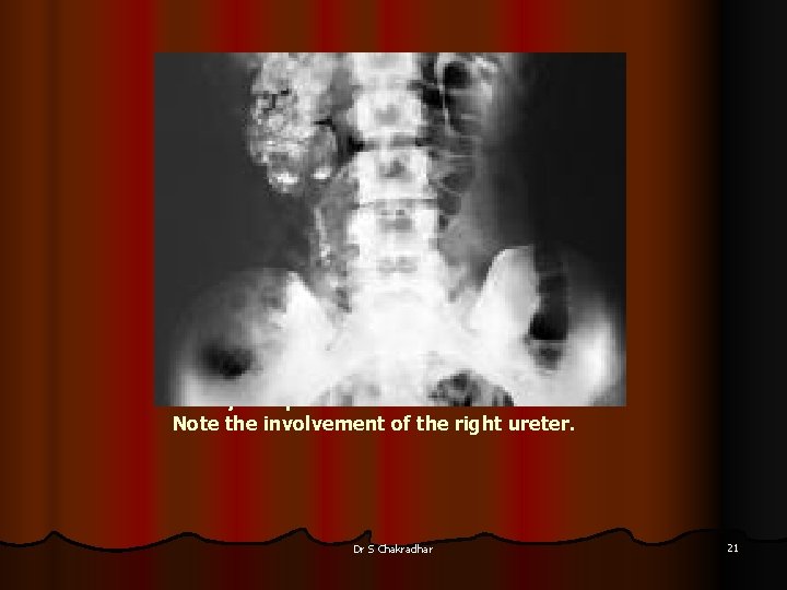 Lobar calcification in a large destroyed right kidney in a patient with renal tuberculosis.