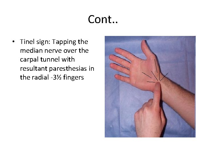 Cont. . • Tinel sign: Tapping the median nerve over the carpal tunnel with