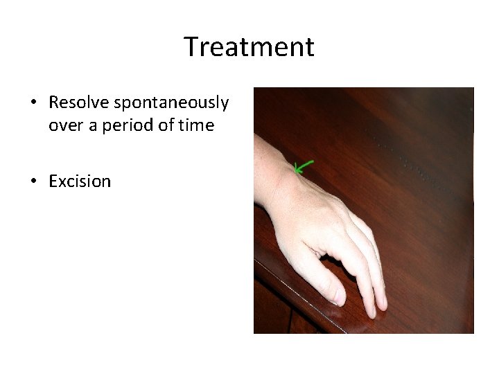 Treatment • Resolve spontaneously over a period of time • Excision 