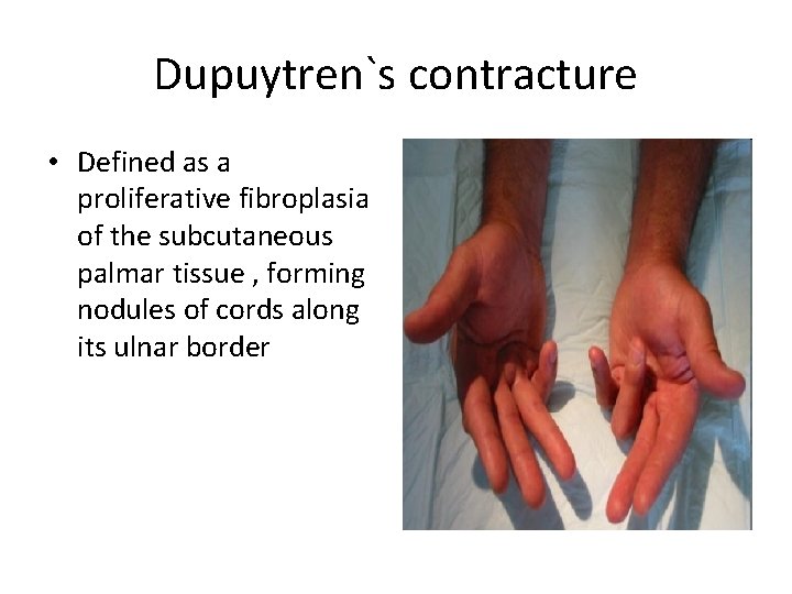 Dupuytren`s contracture • Defined as a proliferative fibroplasia of the subcutaneous palmar tissue ,