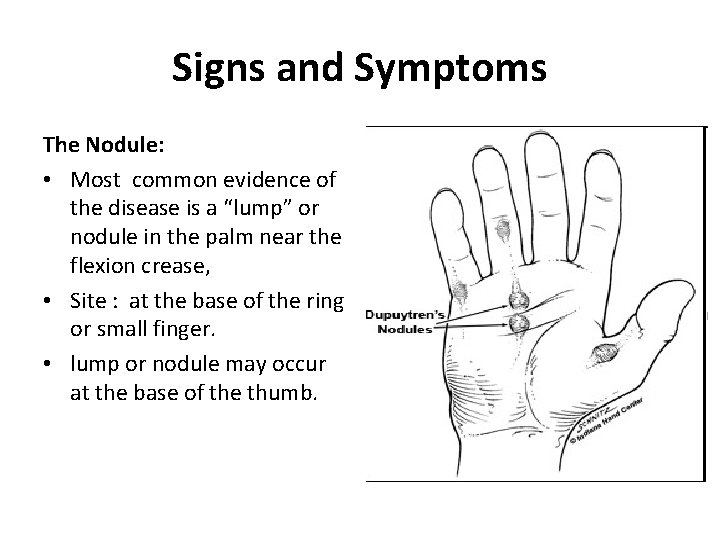 Signs and Symptoms The Nodule: • Most common evidence of the disease is a