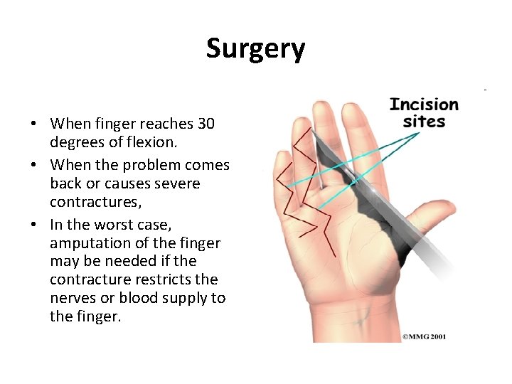 Surgery • When finger reaches 30 degrees of flexion. • When the problem comes