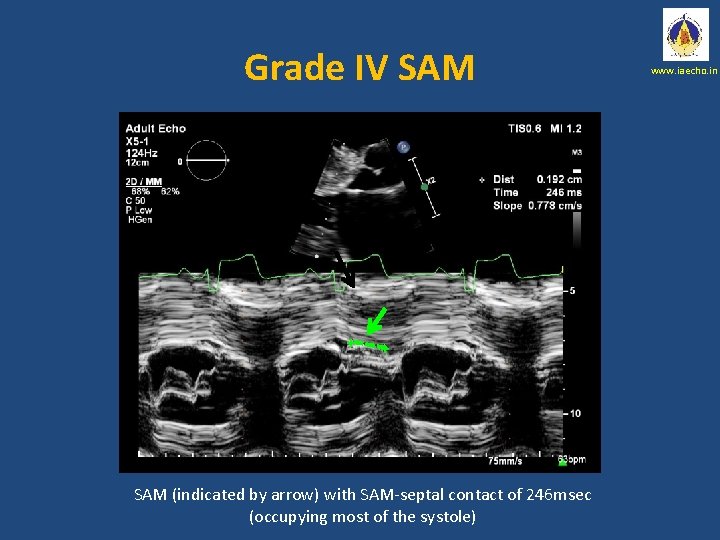 Grade IV SAM + + SAM (indicated by arrow) with SAM-septal contact of 246