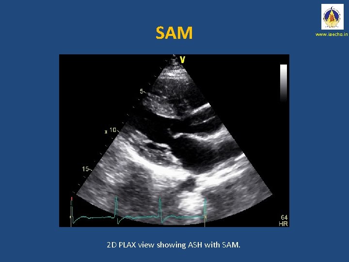 SAM 2 D PLAX view showing ASH with SAM. www. iaecho. in 