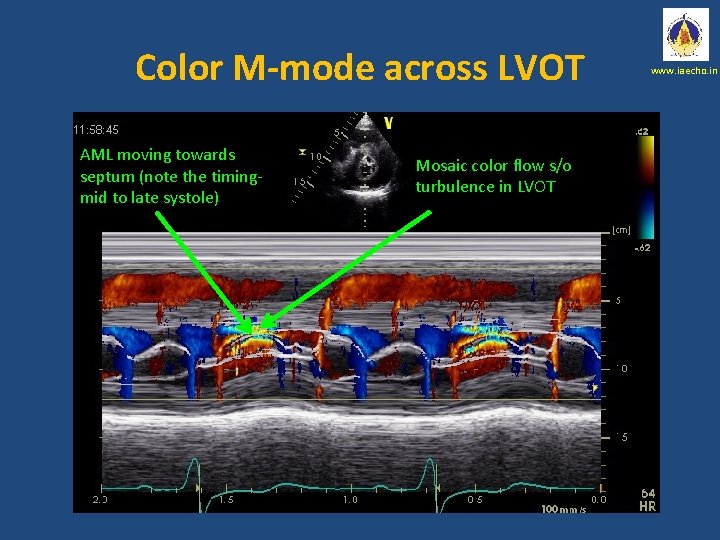 Color M-mode across LVOT AML moving towards septum (note the timingmid to late systole)