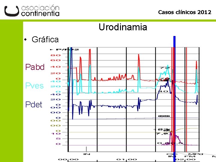 Casos clínicos 2012 Urodinamia • Gráfica Pabd Pves Pdet 