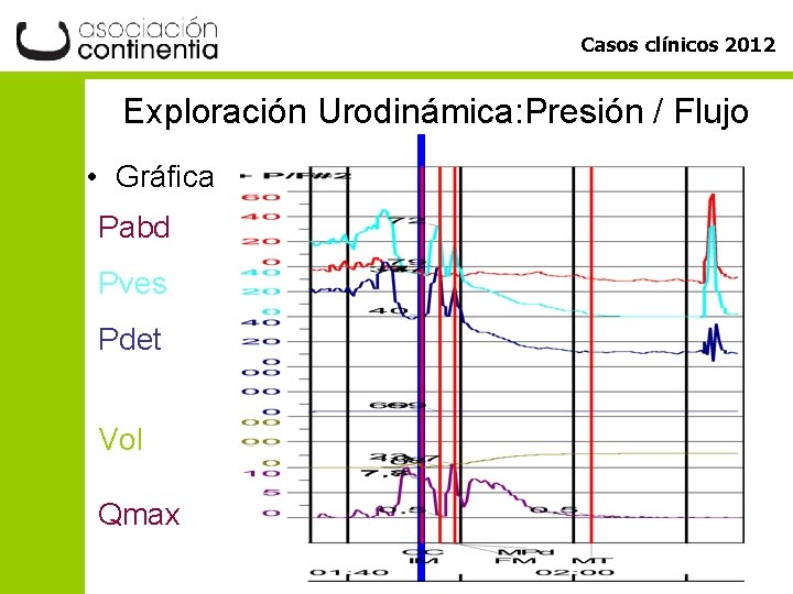 Casos clínicos 2012 Exploración Urodinámica: Presión / Flujo • Gráfica Pabd Pves Pdet Vol