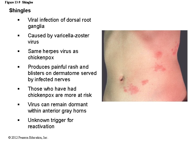 Figure 13 -9 Shingles § Viral infection of dorsal root ganglia § Caused by