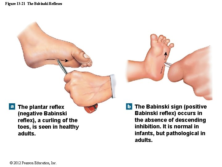 Figure 13 -21 The Babinski Reflexes The plantar reflex (negative Babinski reflex), a curling