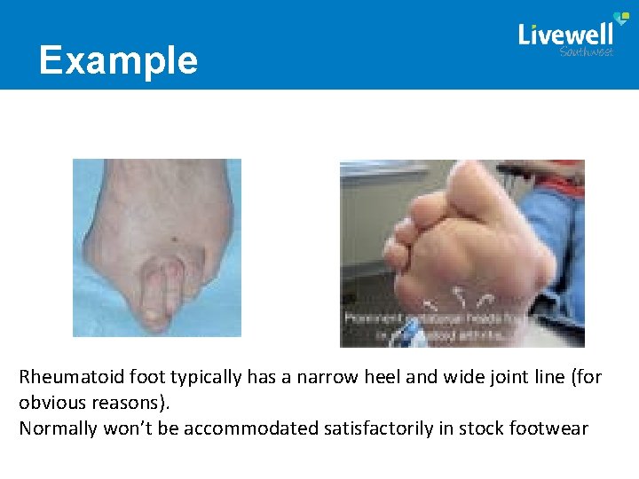 Example Rheumatoid foot typically has a narrow heel and wide joint line (for obvious